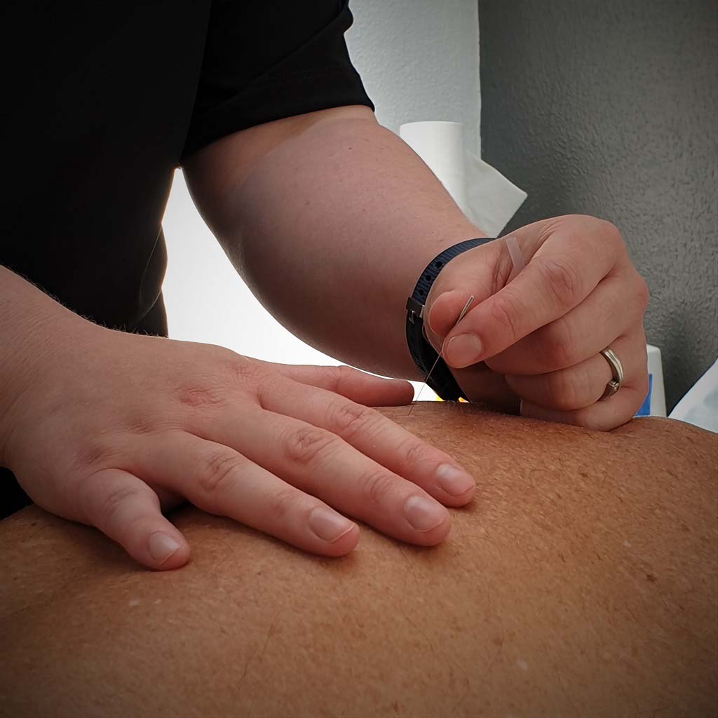 Acupuncture treatment session at Trinity Physiotherapy