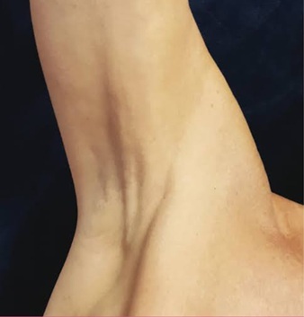 Recovery exercises after breast cancer surgery